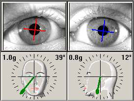 Stopień skrętu oka w odniesieniu do pozycji głowy.